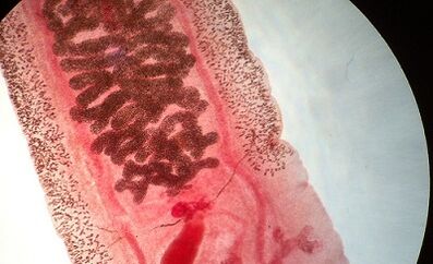 Human static disease