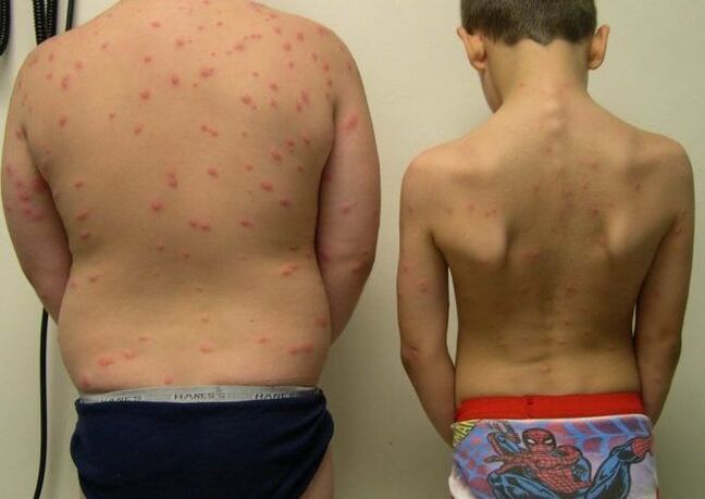 Skin rash with worms on the skin