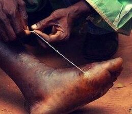 Parasitized at a person's feet