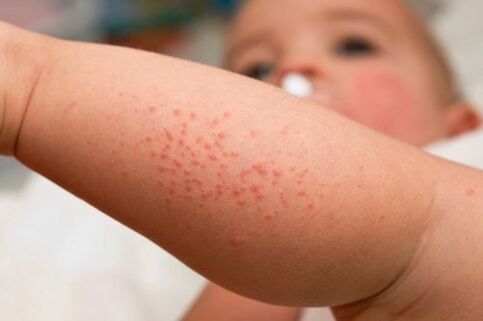 Allergies in children are symptoms of the presence of worms