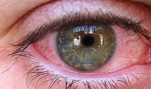 Causes of parasites in human eyes
