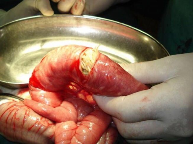 Chessi parasite dangerous to humans